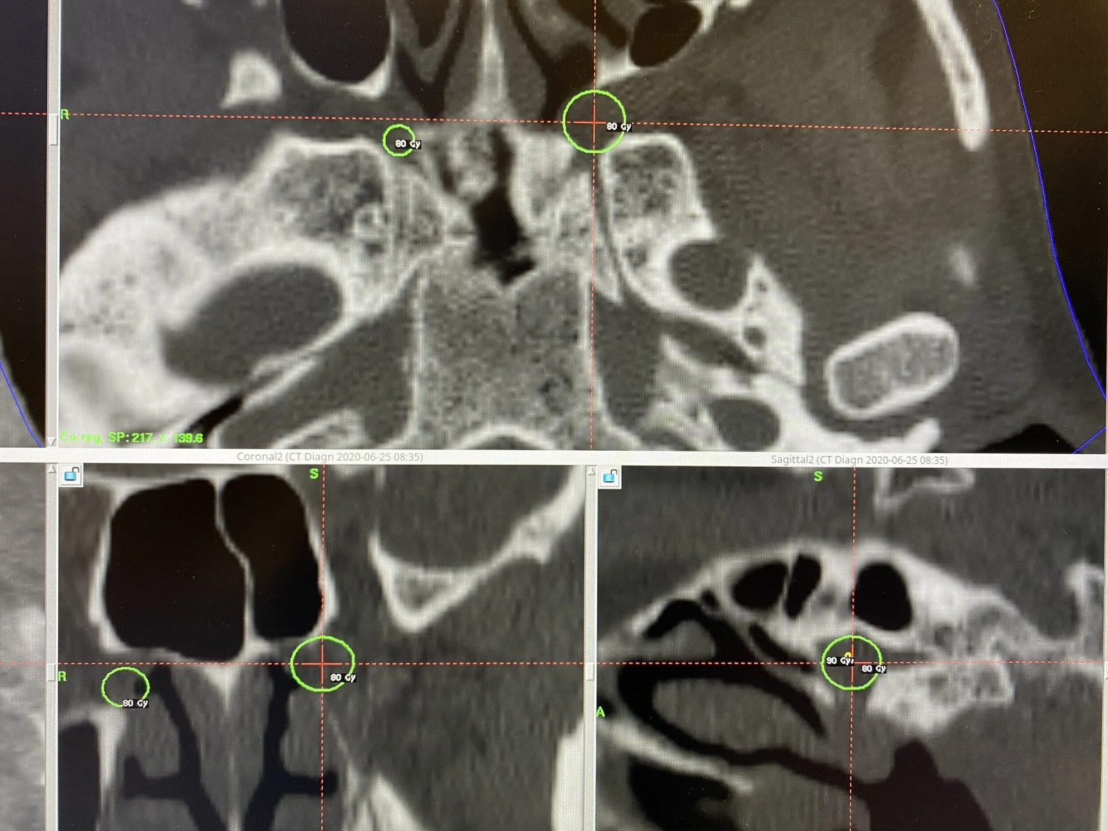 Gamma Knife of the pterygopalatine (sphenopalatine) ganglion in a case of severe facial pain