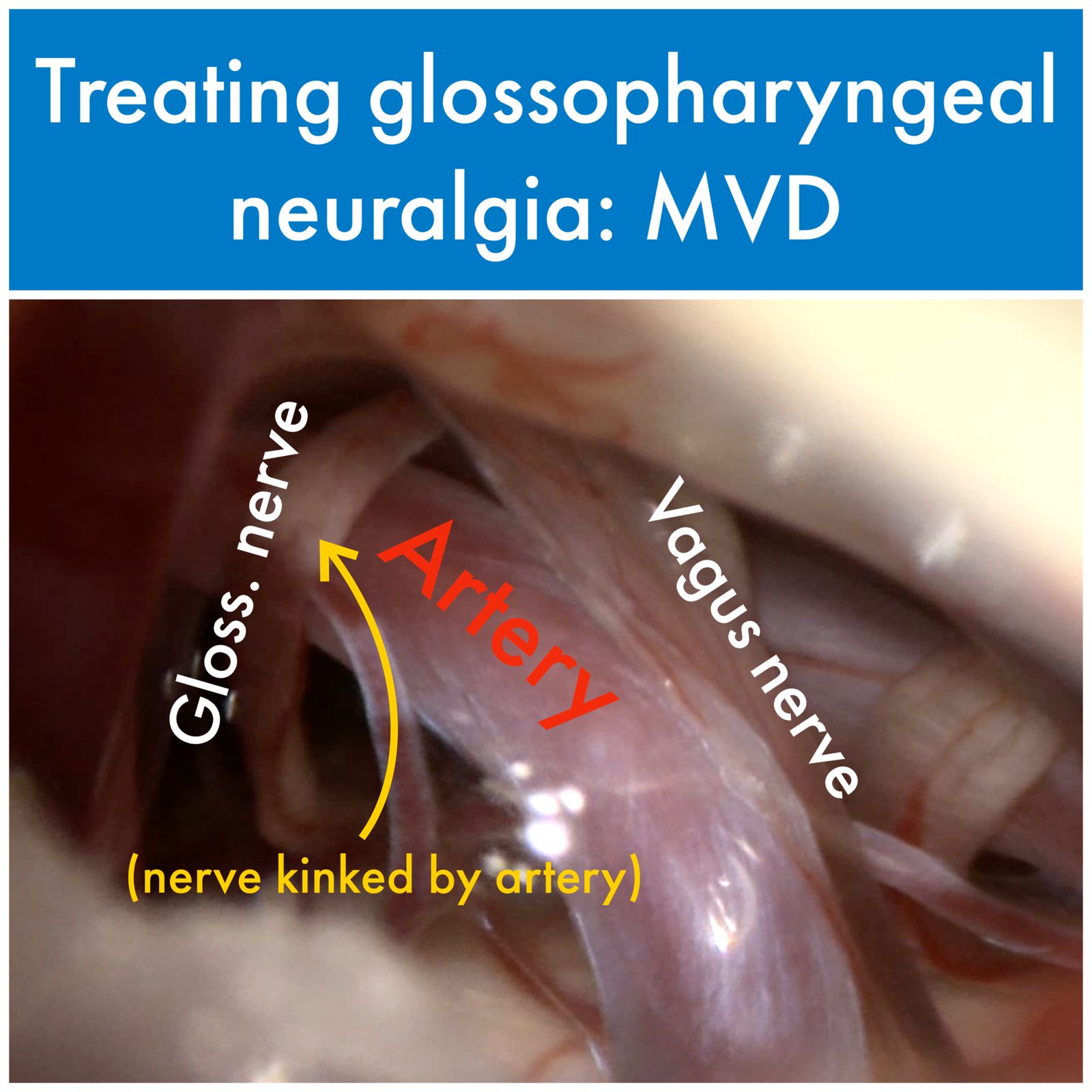 Treating glossopharyngeal neuralgia with microvascular decompression: the glossopharyngeal and vagus nerves, with an artery kinking the nerve