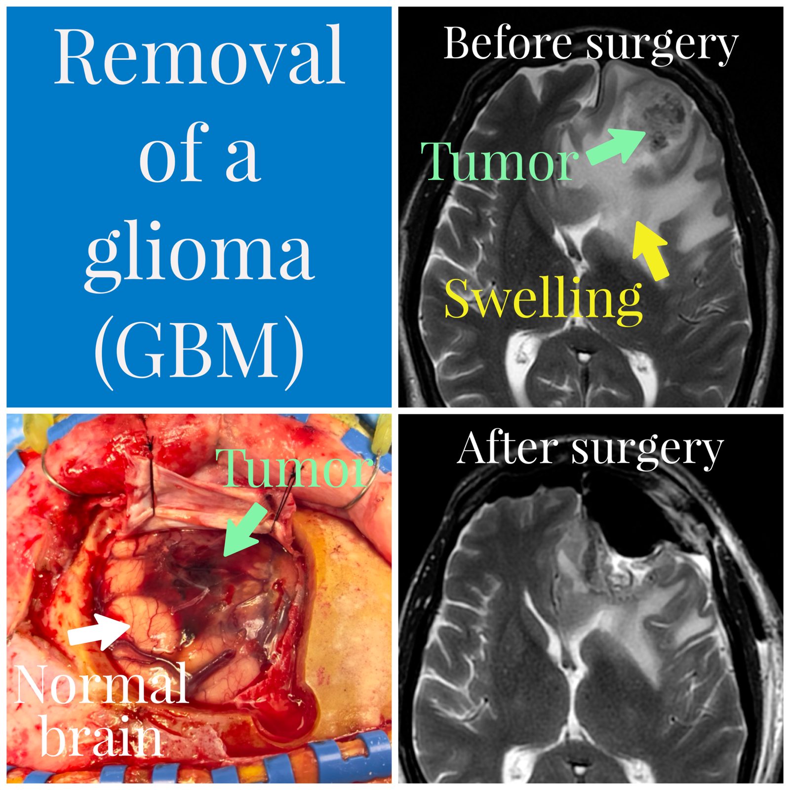 Removal of a glioma (GBM): before and after MRI scans showing the tumor and swelling, beside an operative photograph