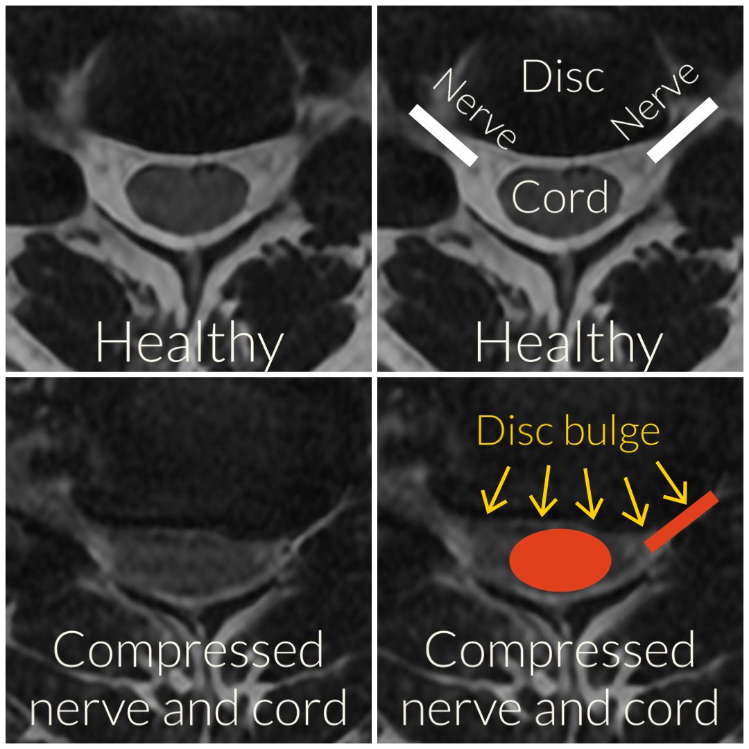 MRI of the cervical spine: the top panels show a healthy disc, spinal cord, and nerve roots, and the lower panels show a disc bulge compressing the spinal cord and a nerve root