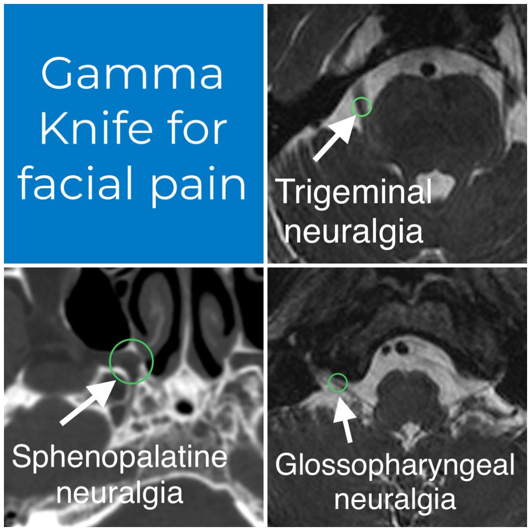 Gamma Knife for facial pain: MRI scans showing the targets for trigeminal, sphenopalatine, and glossopharyngeal neuralgia