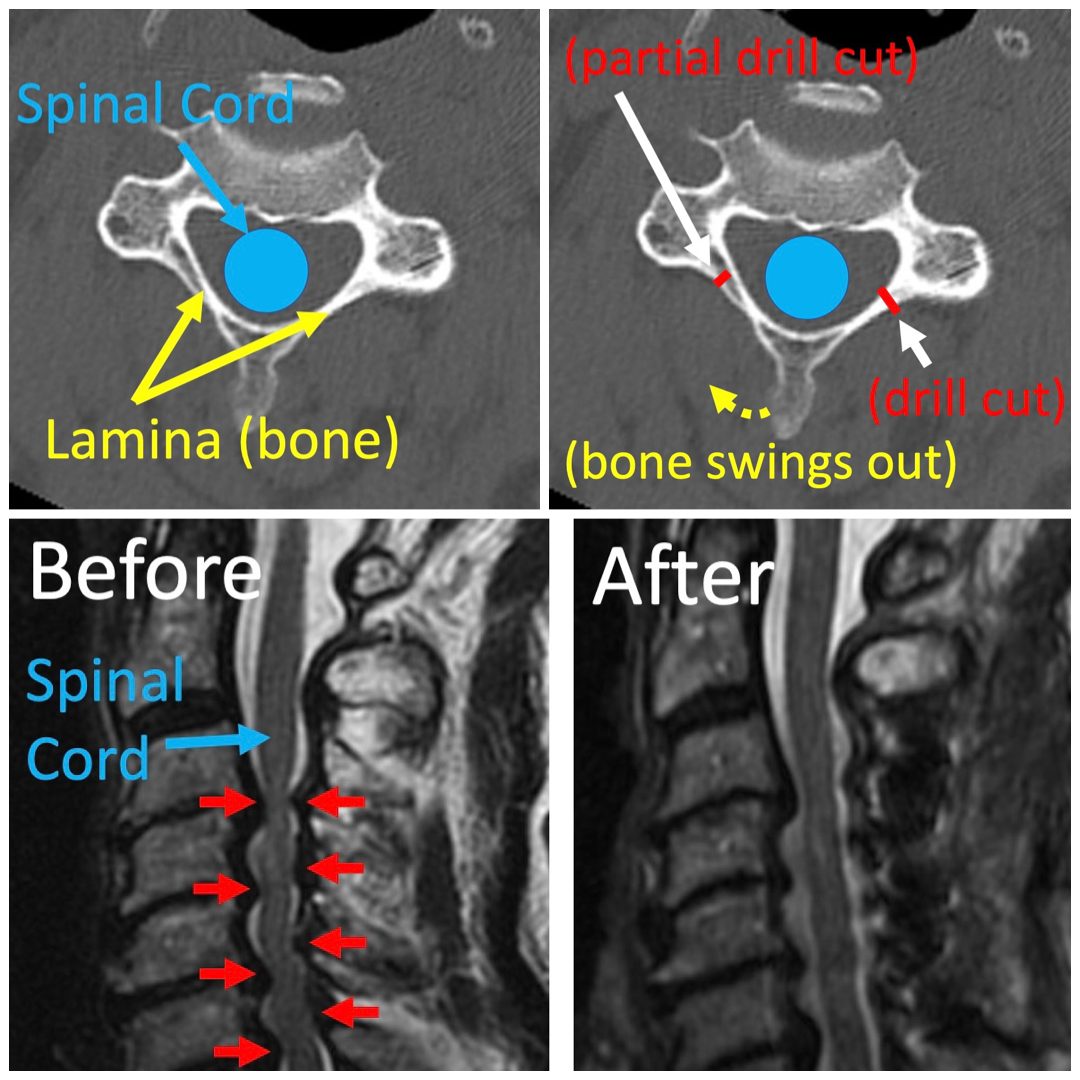 Diagram of a laminoplasty, with the lamina hinged open to make more room for the spinal cord, beside before and after MRI scans