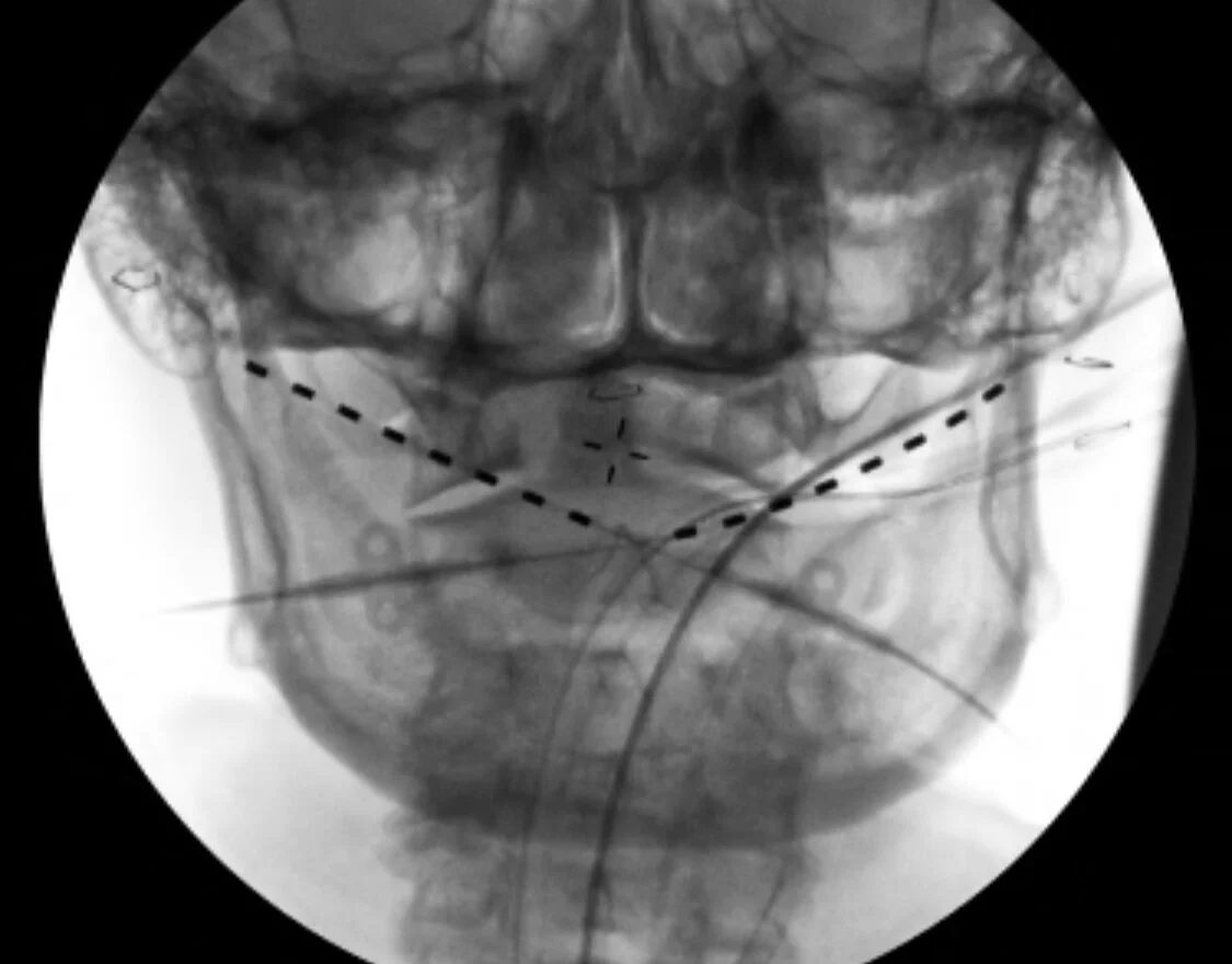 Example trial implant of occipital nerve stimulator leads in a patient with occipital neuralgia