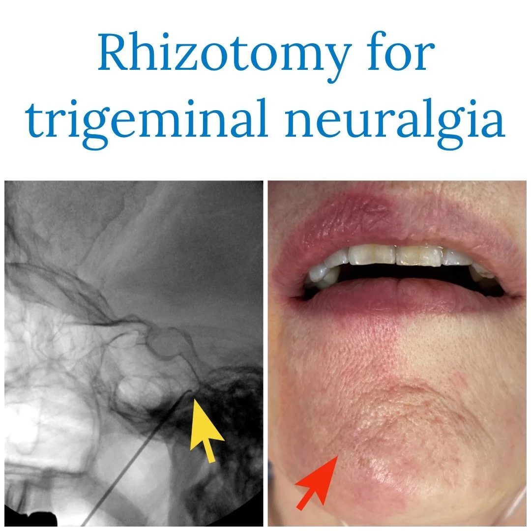 Rhizotomy for trigeminal neuralgia: an X-ray with the needle position marked beside a photograph of the lower face