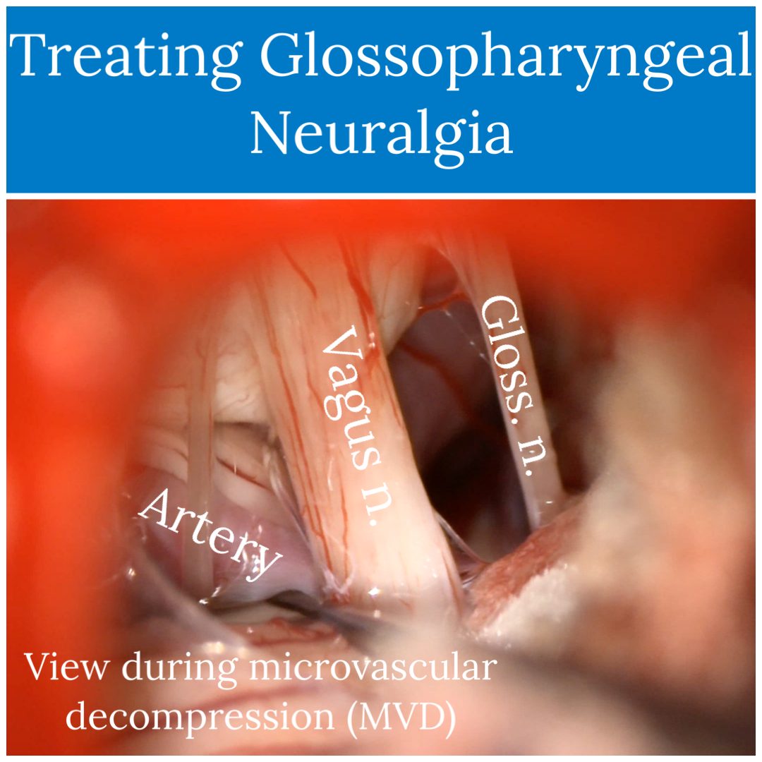 Treating glossopharyngeal neuralgia: operative view during microvascular decompression, with the nerve and an artery labeled
