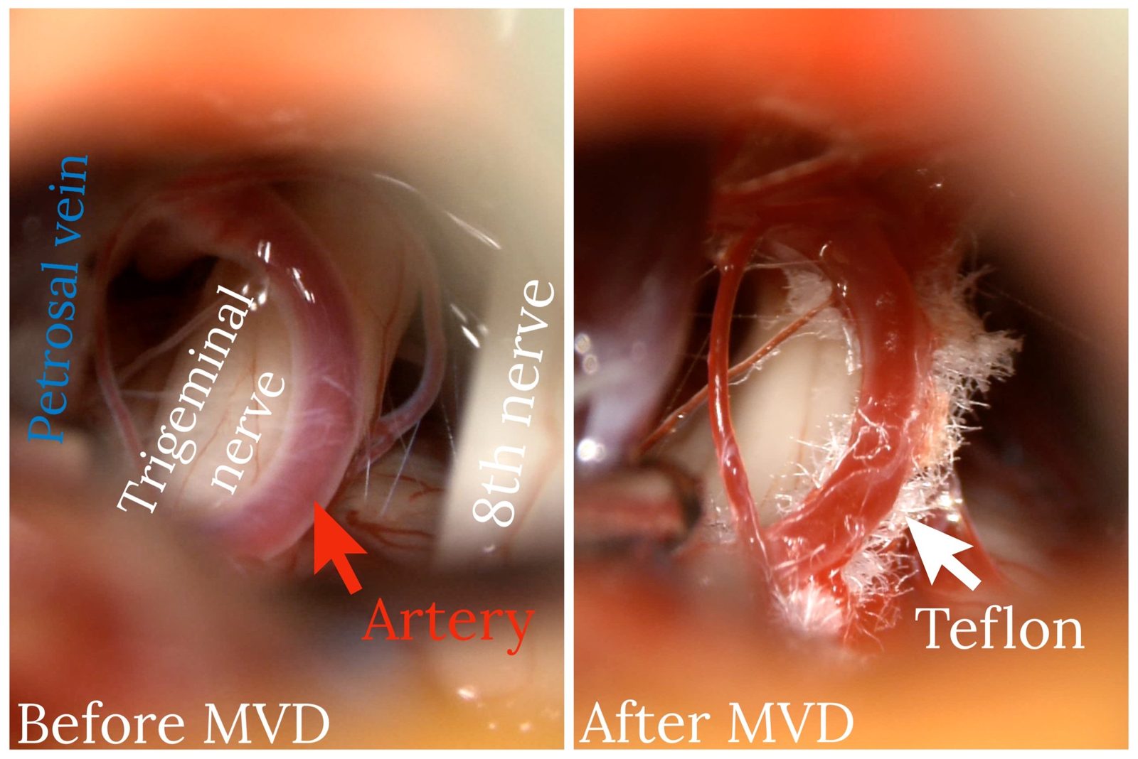 Before and after microvascular decompression: operative photographs of the trigeminal nerve and an artery, then Teflon in place