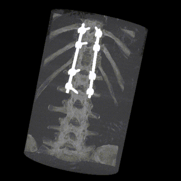 Animated 3D CT scan of the spine showing screws and rods in place