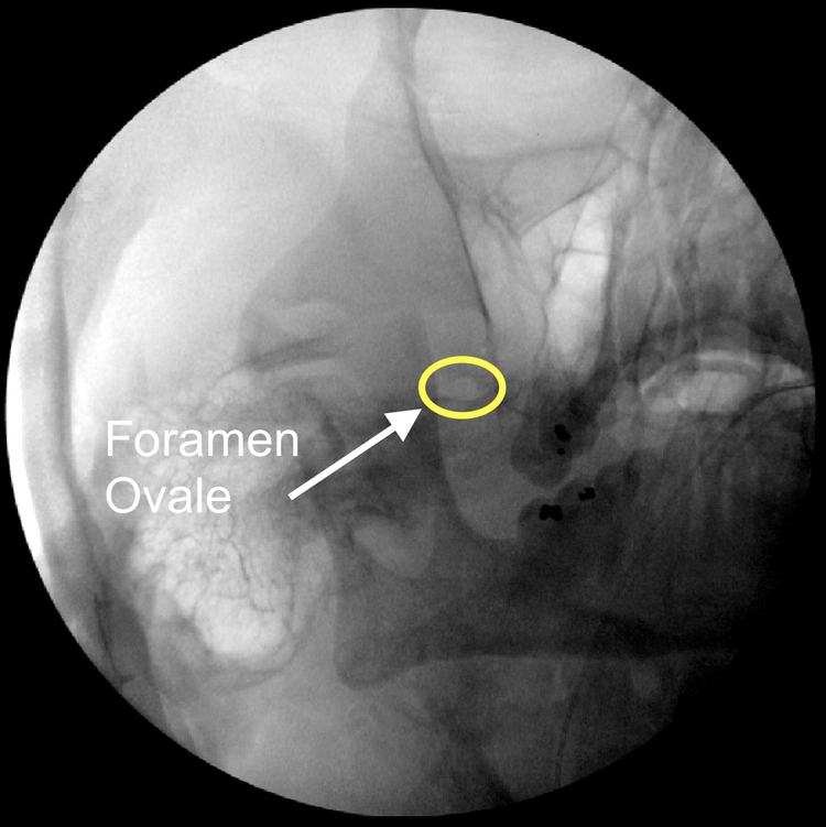 X-ray image with the foramen ovale circled and labeled