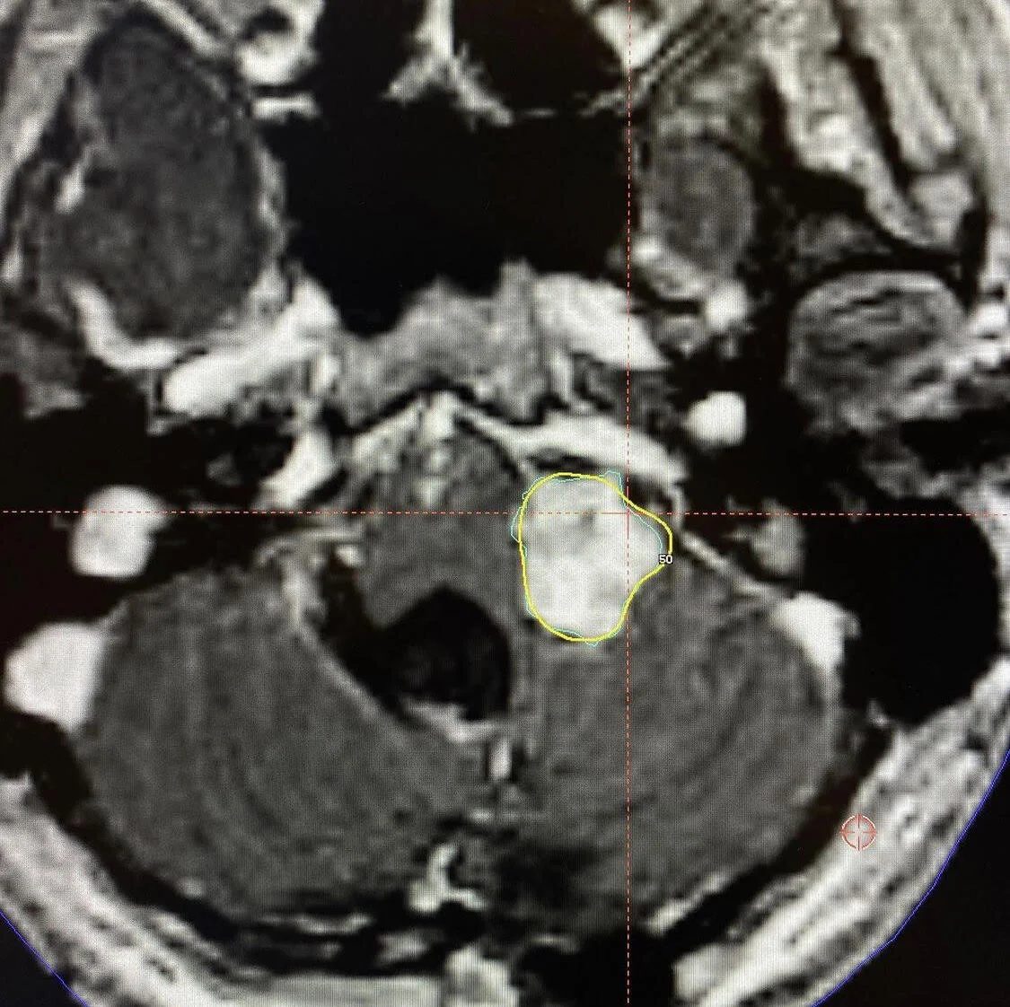 MRI of the brain showing a papilloma treated with Gamma Knife