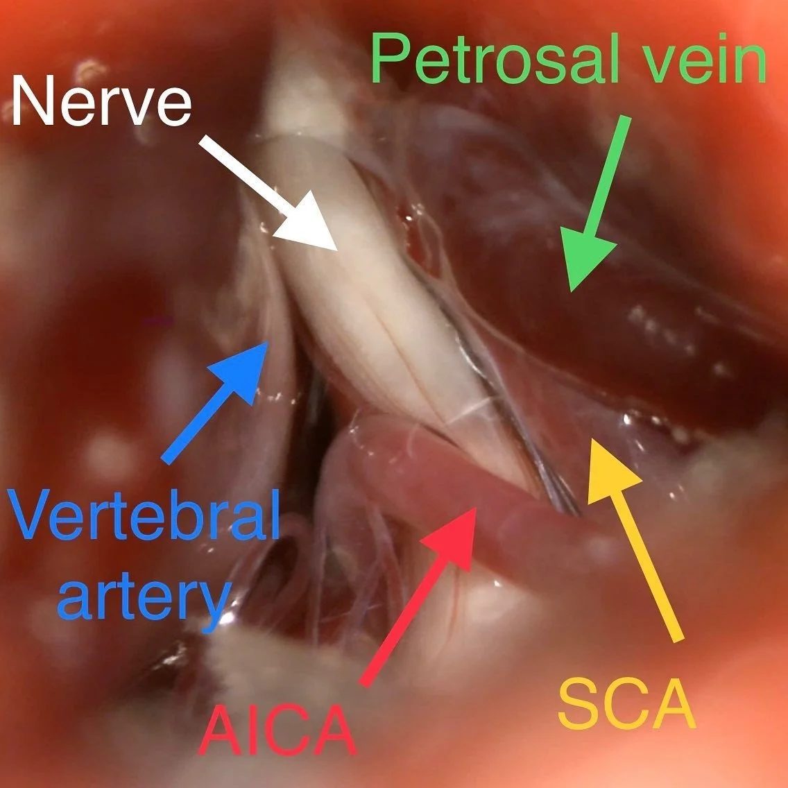 Microvascular decompression for trigeminal neuralgia