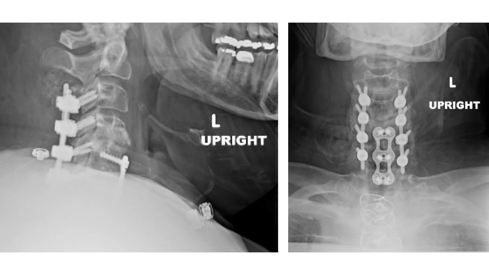 Cervical fusion performed for neck pain and cervical myelopathy