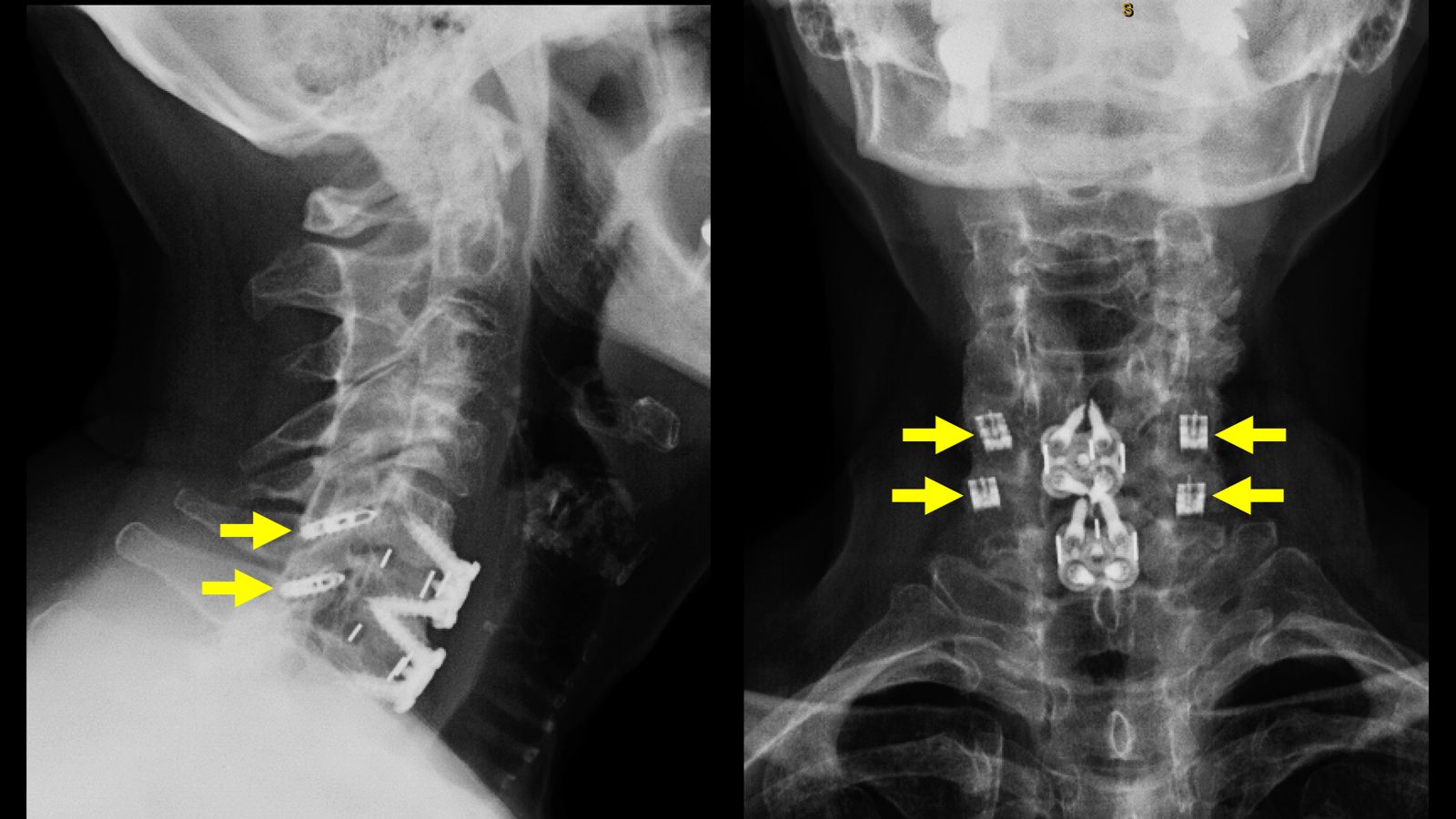 CORUS facet cages (yellow arrows) used to support a C5-6 and C6-7 ACDF