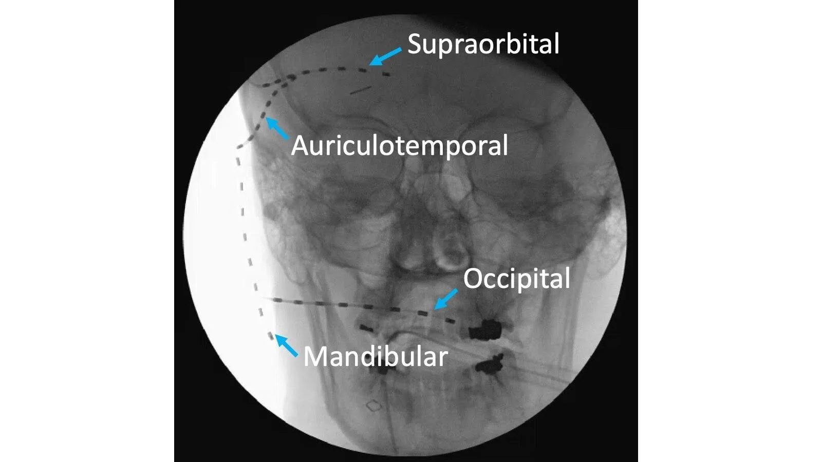 Example X-ray of nerve stimulation for facial pain targeting several different nerves
