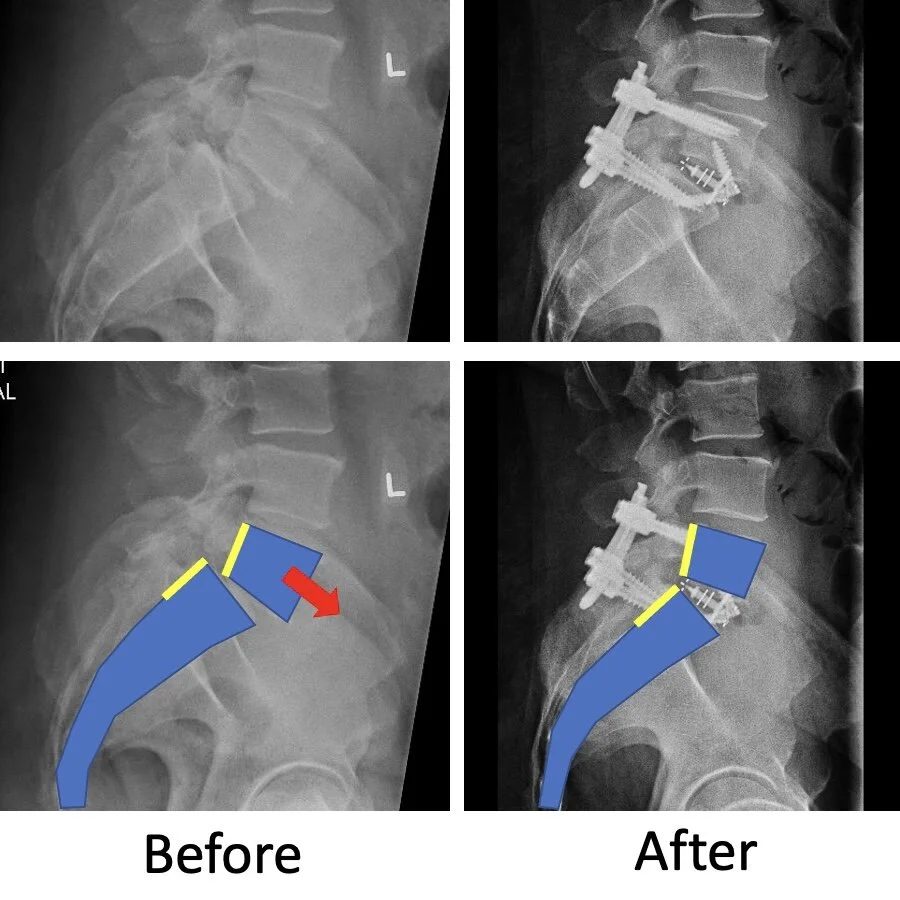 Correction of spondylolisthesis with an ALIF