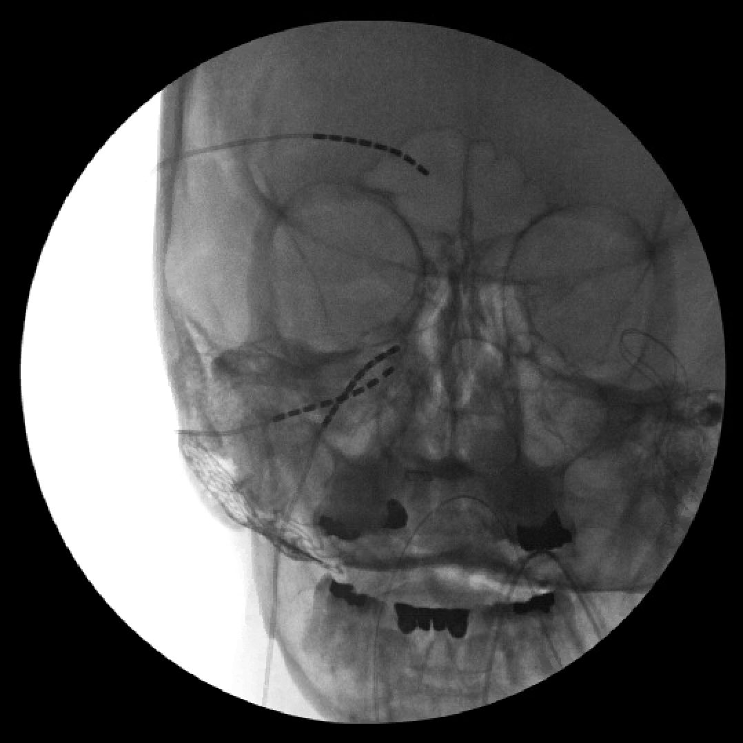 X-ray showing trigeminal nerve stimulation targeting the supraorbital, infraorbital, and trigeminal nerves in a case of trigeminal neuropathic pain