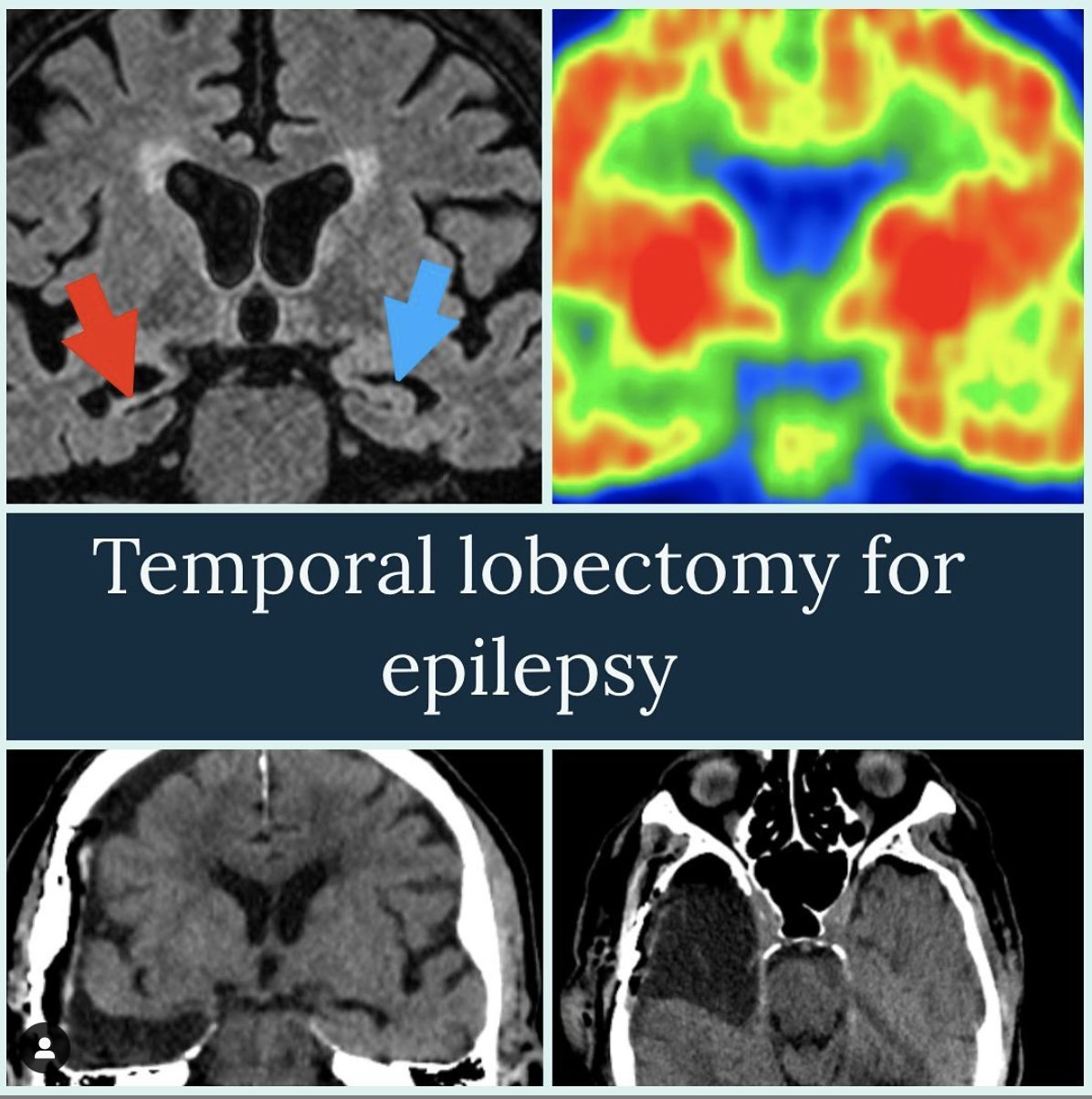 Temporal lobectomy for epilepsy: MRI and PET scans and a diagram