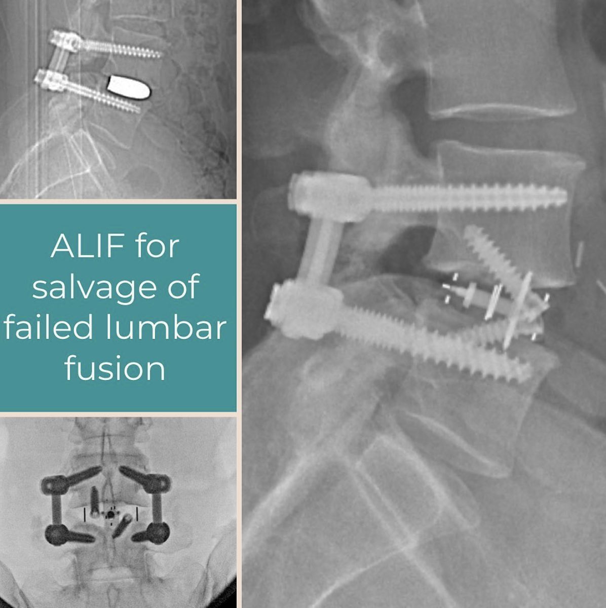 Images from a patient with a failed TLIF (top left) by another surgeon on whom I performed an ALIF procedure