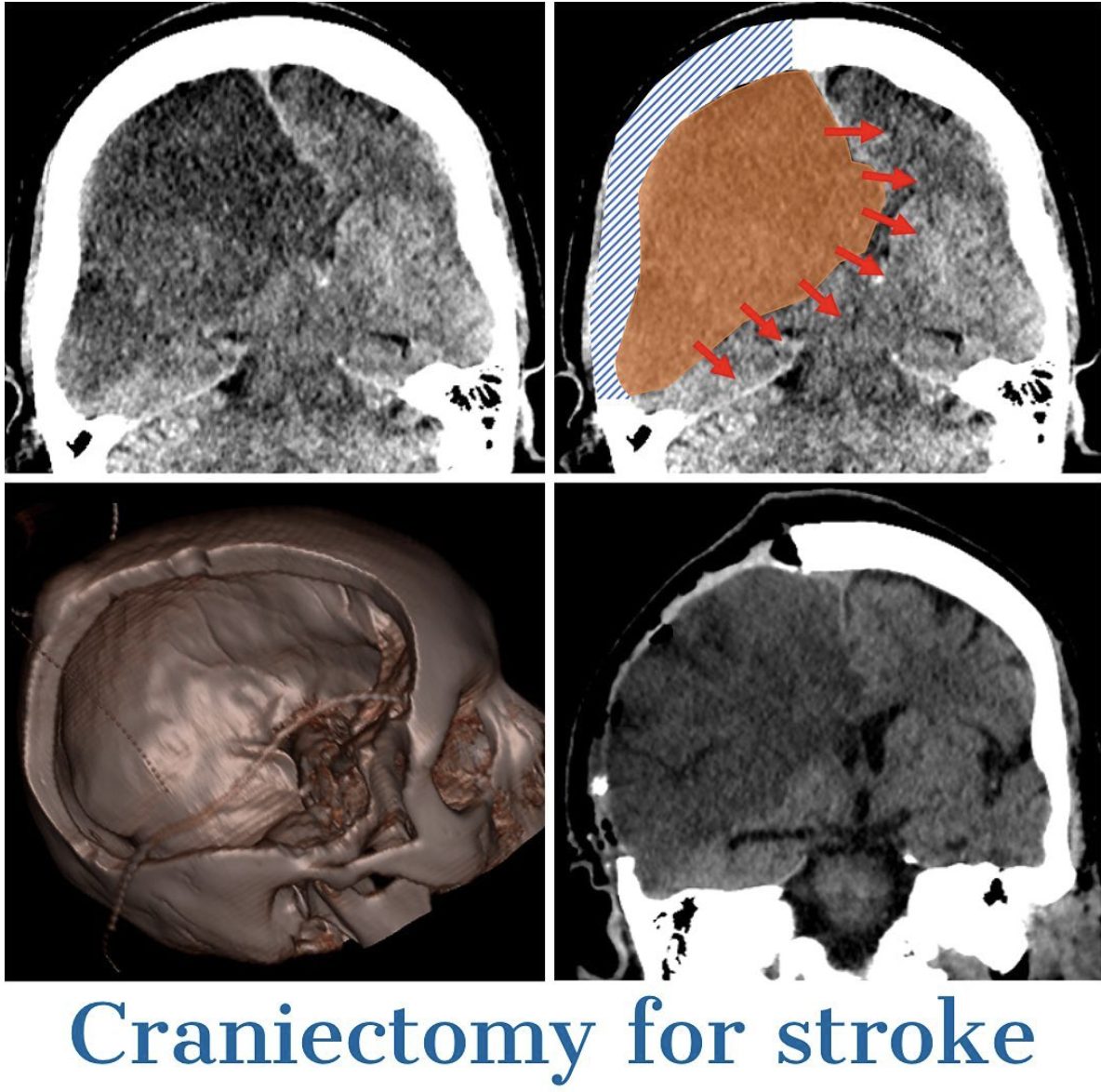 Craniectomy for stroke: CT scans and a 3D reconstruction of the skull