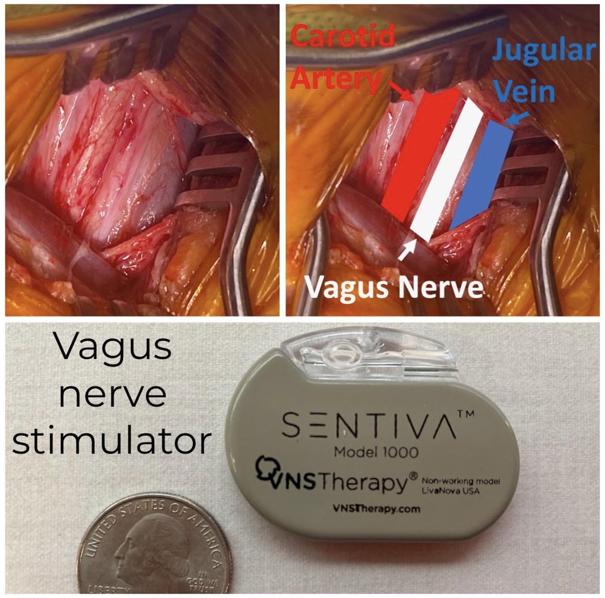 Operative photograph with the vagus nerve labeled, beside a vagus nerve stimulator battery