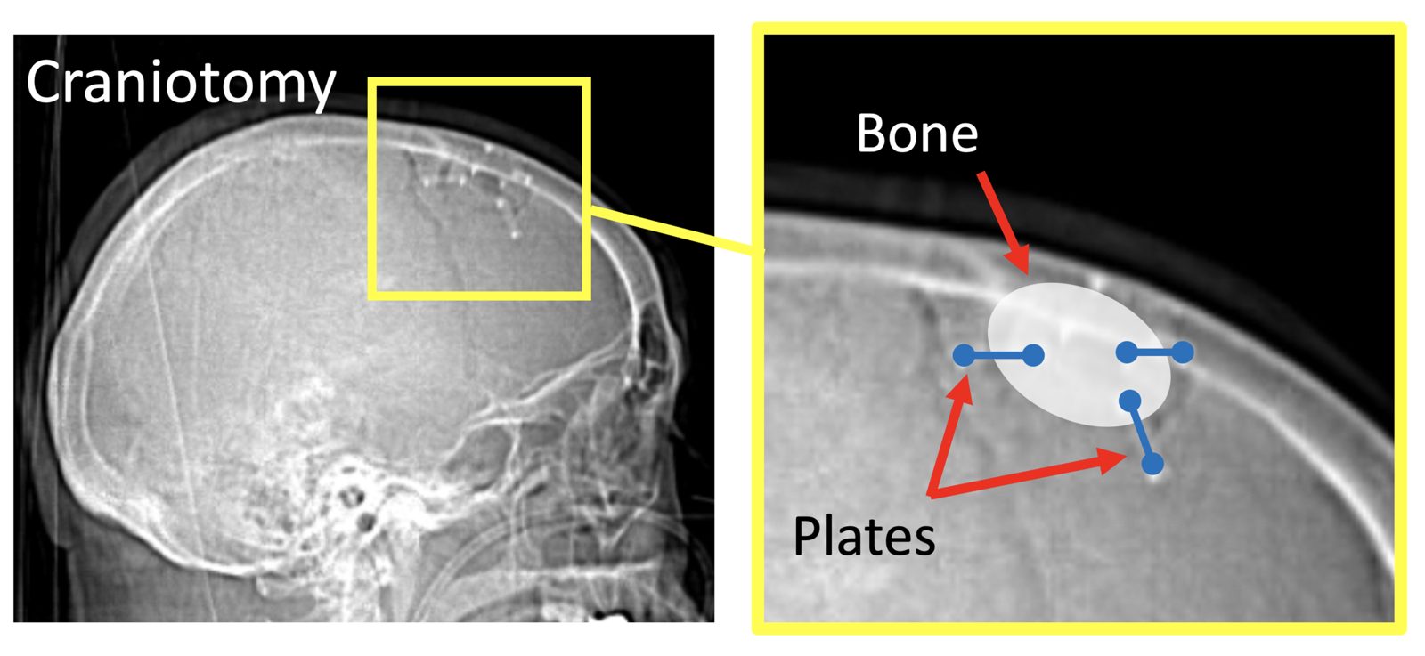 X-rays and illustration of a small frontal craniotomy that was used to remove an intraparenchymal hematoma