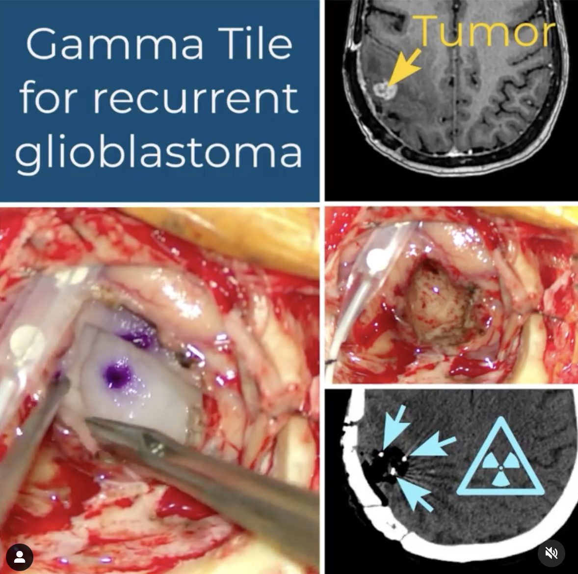 Gamma Tile for recurrent glioblastoma: MRI and operative photographs showing the tumor and the implant