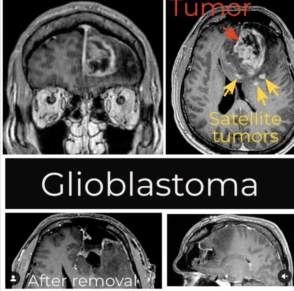 Glioblastoma: MRI scans showing the tumor before removal and the area after removal