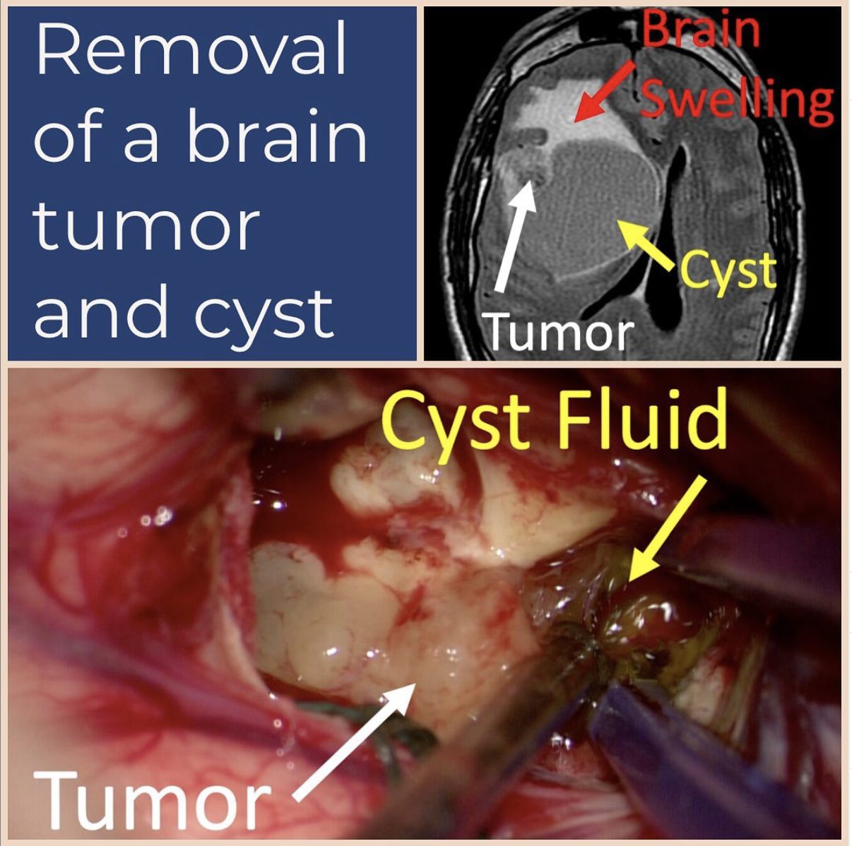 Removal of a brain tumor and cyst: an MRI and an operative photograph showing the tumor and cyst fluid