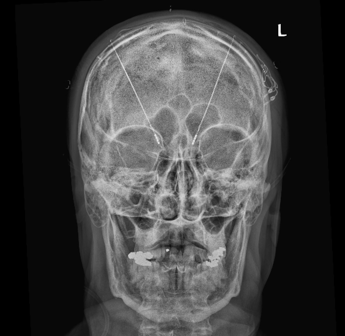 Front-view skull X-ray showing two thin deep brain stimulation wires that pass through the top of the skull into the brain