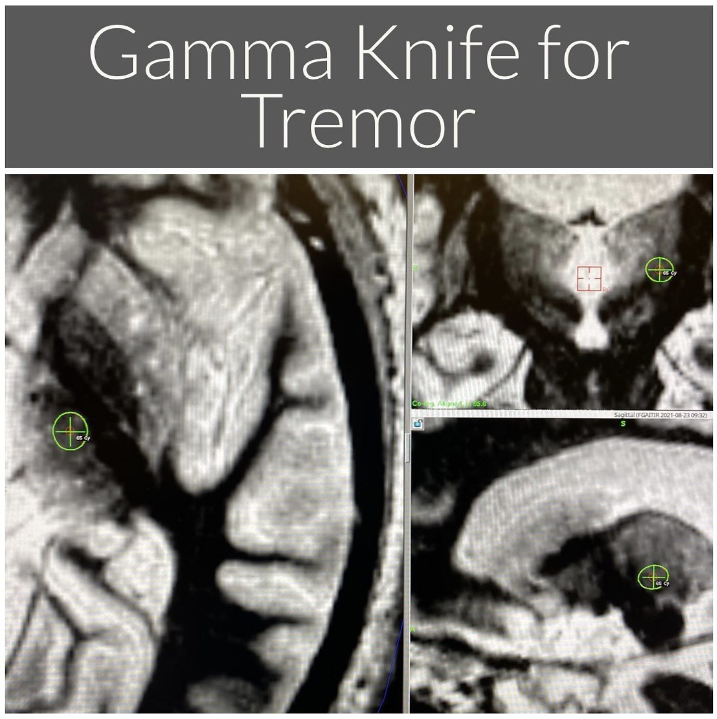 Gamma Knife for tremor: MRI scans showing the treatment target