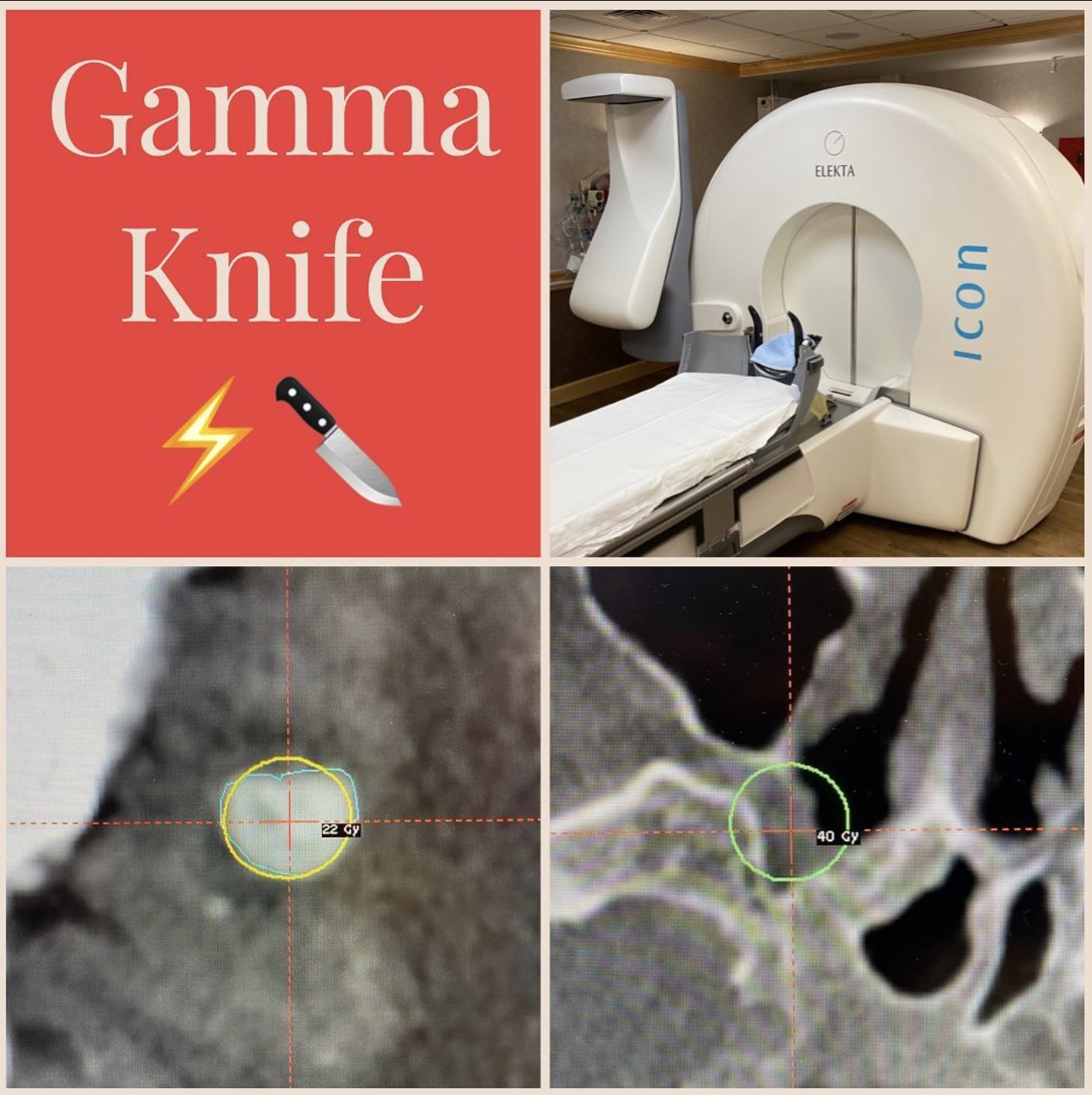 Gamma Knife: a Gamma Knife machine and an MRI showing the treatment target