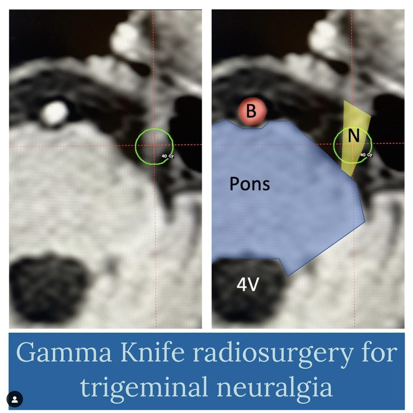 Gamma Knife radiosurgery for trigeminal neuralgia: an MRI showing the target on the trigeminal nerve near the pons