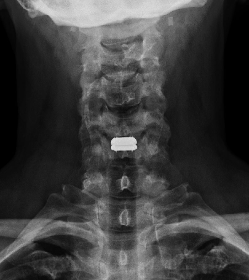 Front-view X-ray of the neck after a cervical disc replacement, with the artificial disc visible between two vertebrae
