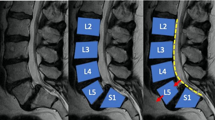 MRI of the lumbar spine with the vertebrae labeled from L2 to S1 and the slipped vertebra marked