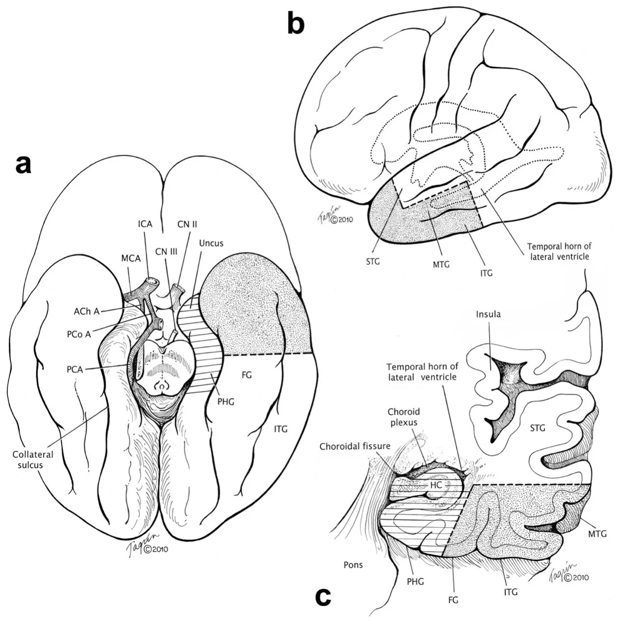 Illustrations of a temporal lobectomy from below (a), the side (b), and in cross-section (c)
