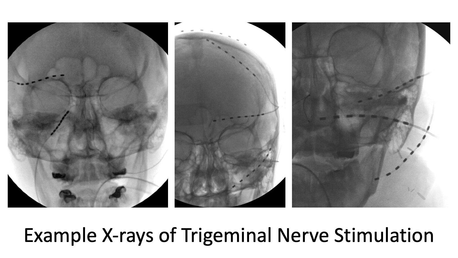 Example X-rays of trigeminal nerve stimulation, showing the electrode leads in three views