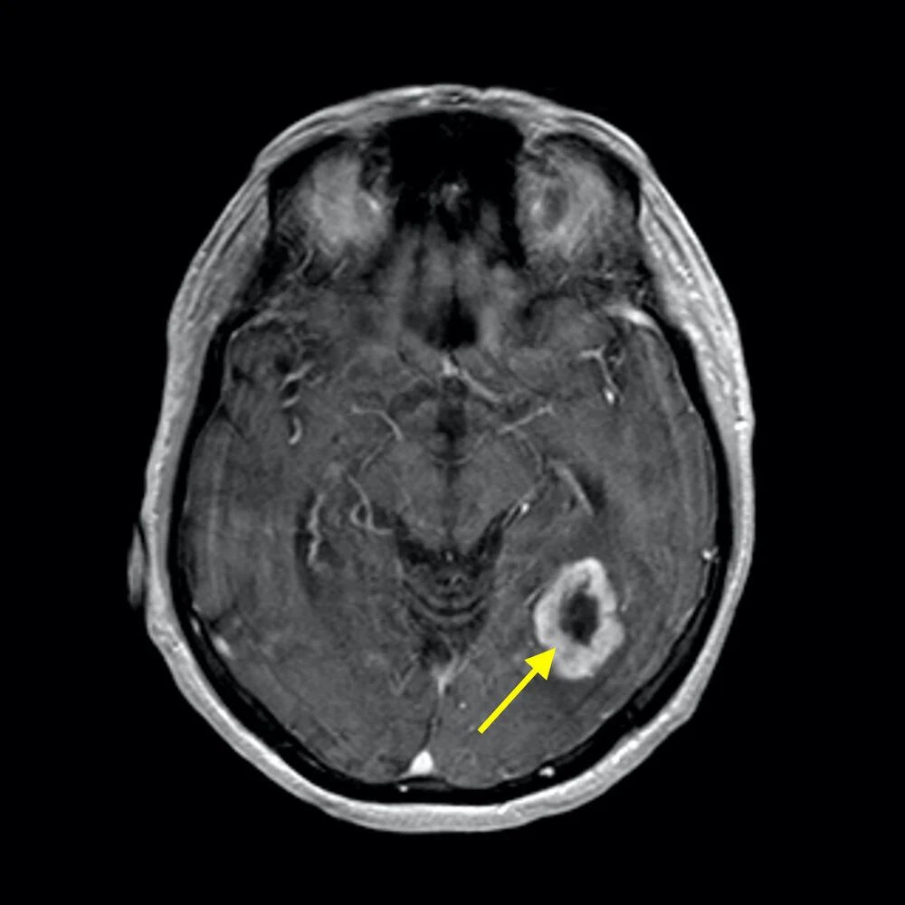 MRI of the brain showing a glioma marked by a yellow arrow