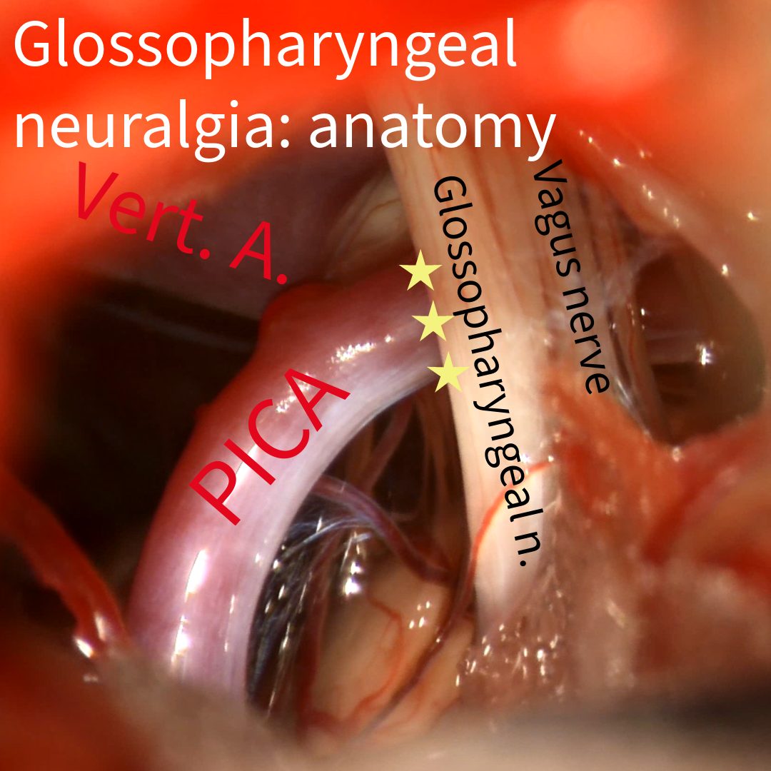Glossopharyngeal neuralgia anatomy: operative photograph with the PICA artery, the glossopharyngeal nerve, and the vagus nerve labeled